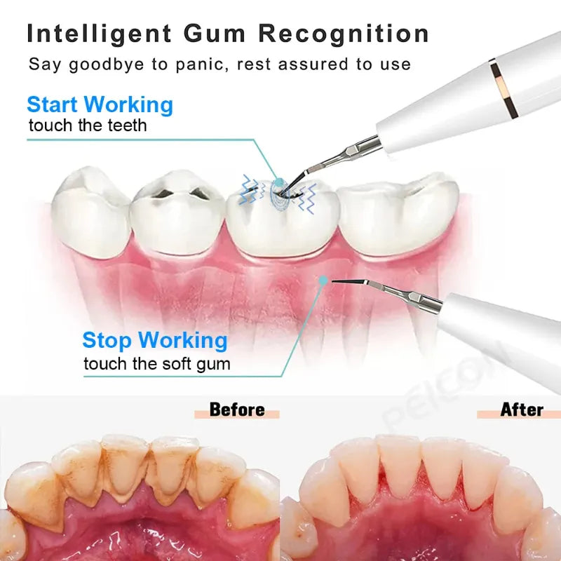 Dental tool with text on intelligent gum recognition and before-after comparison of teeth.